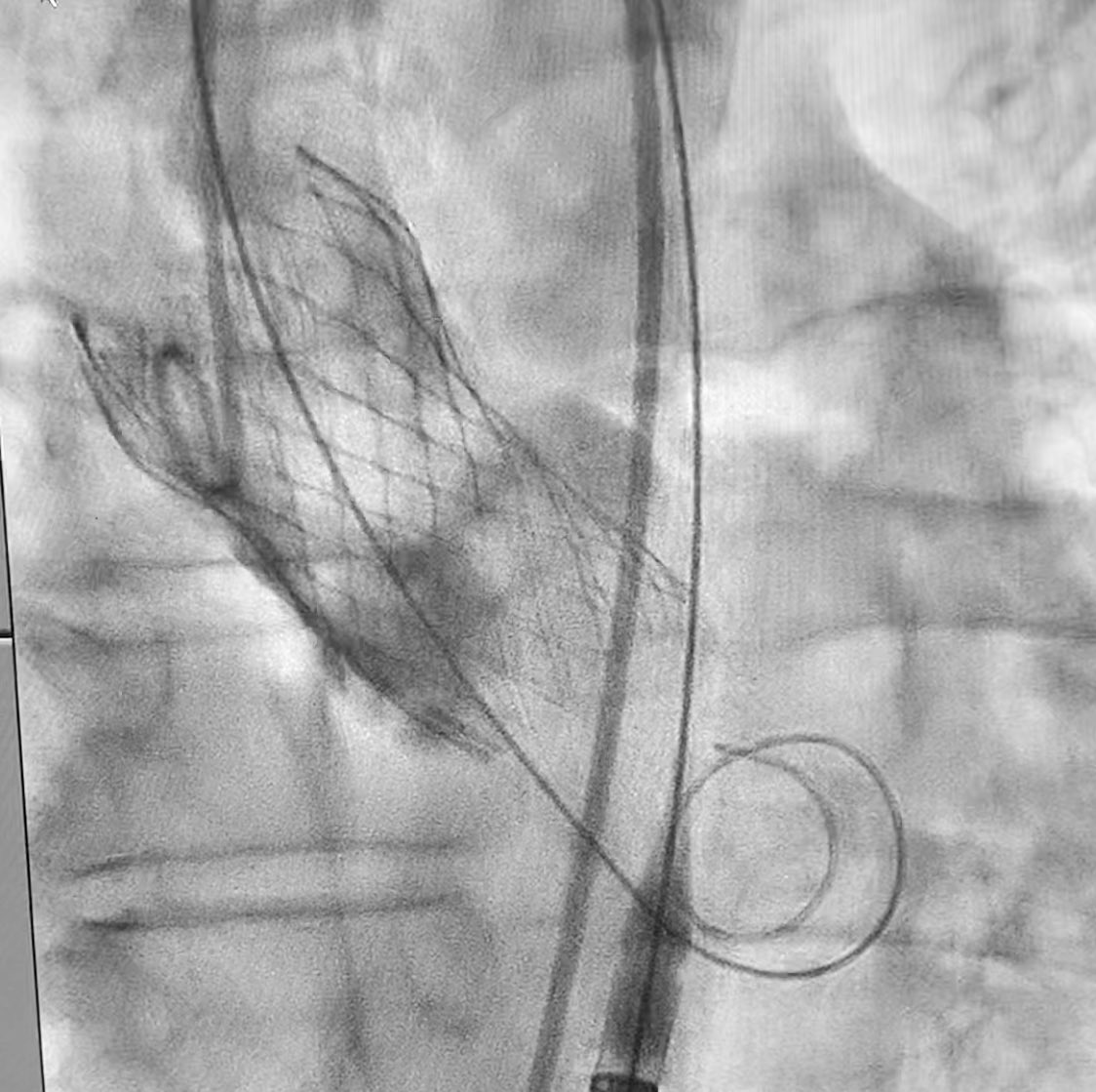 DrNayef1's tweet photo. 77 Y/O male with severe sympt. #AS NYHC IV, mPG 49 mmhg AVA 1.0 cm underwent successful #TAVR with #evoluteR 29 using #cusp_overlap technique & achieving optimal #Commissural_alignment and excellent final results
(MPG 4.9mmhg, no PVL,no Ecg)
skin to skin time 30 min
@ksmcmedia https://t.co/N4khuegIzI