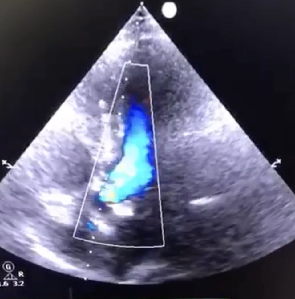 DrNayef1's tweet photo. 77 Y/O male with severe sympt. #AS NYHC IV, mPG 49 mmhg AVA 1.0 cm underwent successful #TAVR with #evoluteR 29 using #cusp_overlap technique & achieving optimal #Commissural_alignment and excellent final results
(MPG 4.9mmhg, no PVL,no Ecg)
skin to skin time 30 min
@ksmcmedia https://t.co/N4khuegIzI