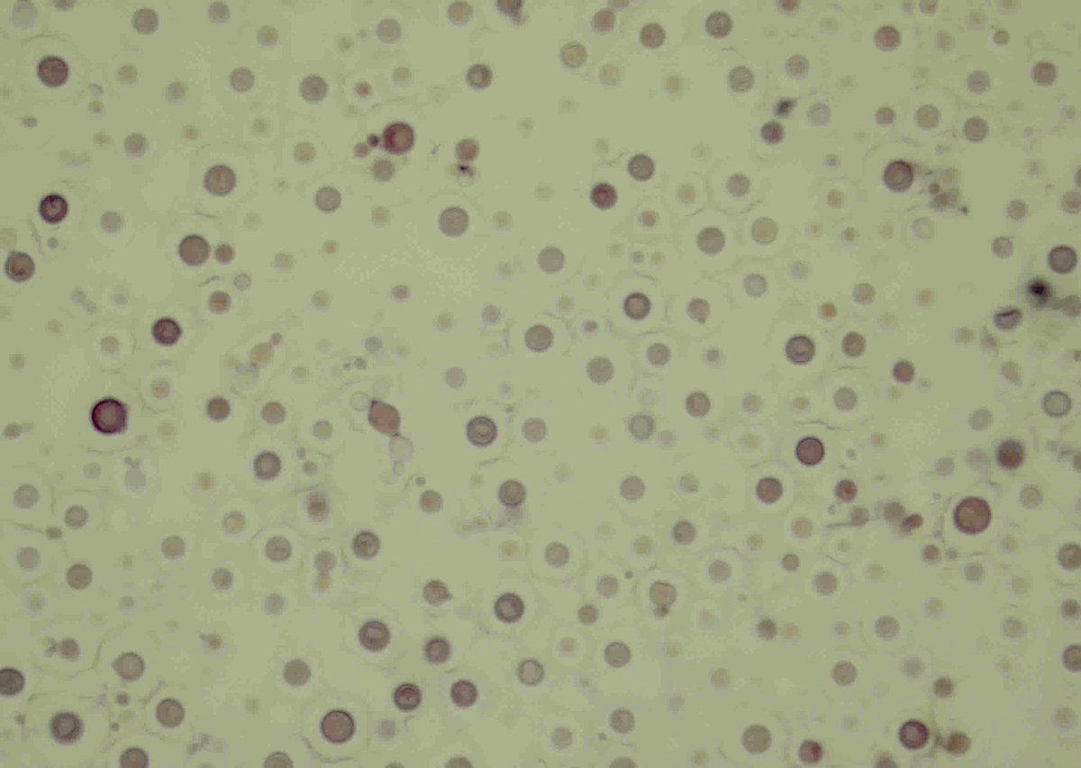 ZMaleki_cyto's tweet photo. Cryptococcus neoformans, CSF, note thick capsules, cytopathology #121 #CytoPro @PathPro @barkanga @IvanaKholova @aakasharmand @NayarRitu @iremessa @ALBoothMD  @PVielh @doc_kartik @mdlozanoe @twmarkc   @IACytology @PathDocBoston @KMirza @tlabiano @britishcytology https://t.co/FXMt1GiHNa