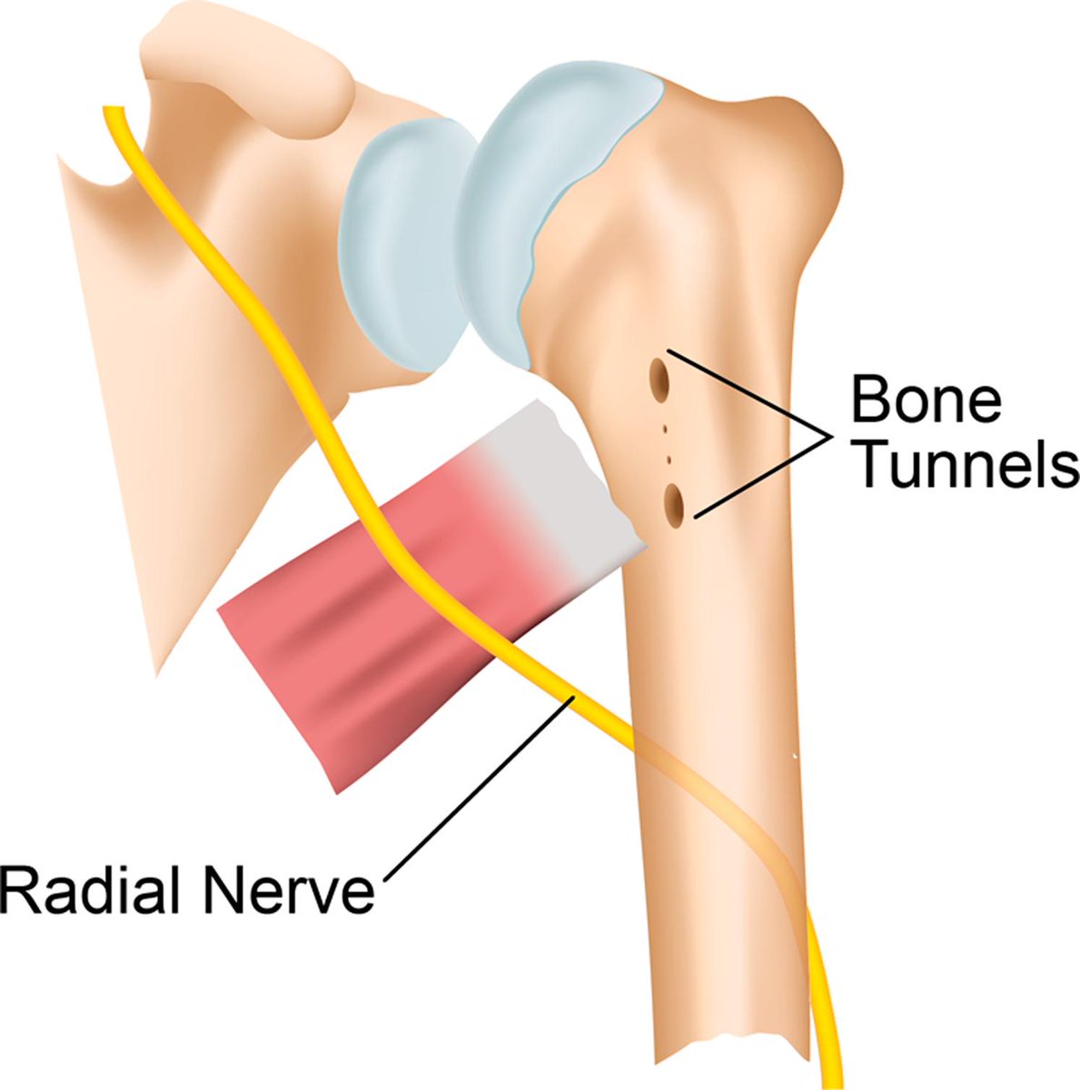 Latissimus Dorsi Myotendinous Repair with Allograft Hamstring Tendon Graft Augmentation

ow.ly/rceV30rs34K