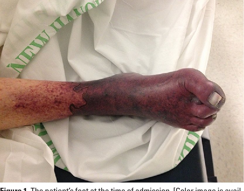 How to remember 🧠 drugs that ⤴️risk of skin hypersensitivity syndromes (SJS, DRESS, TENS)? 🧐 

Back...