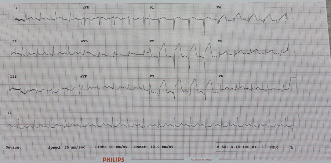 An Anterior wall STEMI. 47 year old lady, has come within 3 hours of onset of chest pain. Angio showed mid LAD thrombotic occlusion. Primary PCI to LAD done successfully.  #PrimaryPCI  #HeartAttack