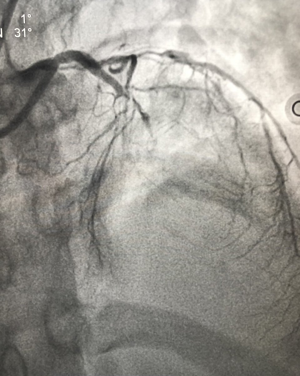 An Anterior wall STEMI. 47 year old lady, has come within 3 hours of onset of chest pain. Angio showed mid LAD thrombotic occlusion. Primary PCI to LAD done successfully.  #PrimaryPCI  #HeartAttack