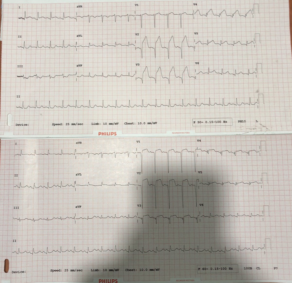 Pre and Post PCI ECG - Note the >70% ST resolution indicating optimal myocardial perfusion.