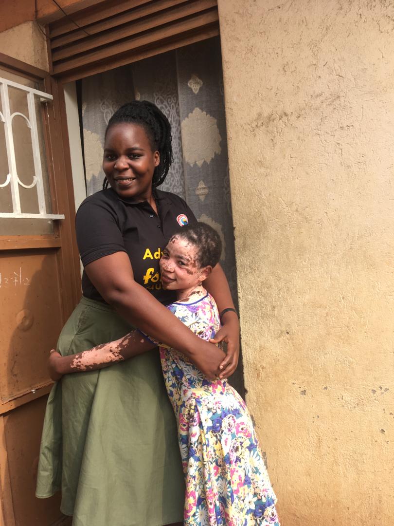 NinyeNBA's tweet photo. Every child should be able to enjoy their childhood no matter their situation.Children with #Vitiligo should not be denied their right to Education & should not be discriminated #GirlsBack2School Campaign is ongoing #GirlsMustLearnUg @100MilCampaign @aasu_72 https://t.co/aa8Z8OtvgD