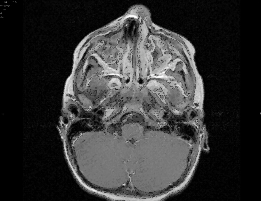 Interestingly, a second MRI showed that there was still some ionic material left behind in the mucosa - the shaded areas corresponding to the right nasal cavity. The symptoms quickly resolved with antibiotics and the child made a good recovery.