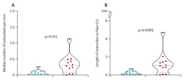 The Lancet Rheumatology (@thelancetrheum) on Twitter photo NEW Research: a single-centre, randomised, double-blind, placebo-controlled, proof of concept trial at <a href="/sheffielduni/">The University of Sheffield</a> <a href="/SheffieldHosp/">Sheffield Hospitals</a> examined the effect of #denosumab on osteolytic lesion activity after total hip #arthroplasty thelancet.com/journals/lanrh… #LancetRheumatology NEW Research: a single-centre, randomised, double-blind, placebo-controlled, proof of concept trial at <a href="/sheffielduni/">The University of Sheffield</a> <a href="/SheffieldHosp/">Sheffield Hospitals</a> examined the effect of #denosumab on osteolytic lesion activity after total hip #arthroplasty thelancet.com/journals/lanrh… #LancetRheumatology
