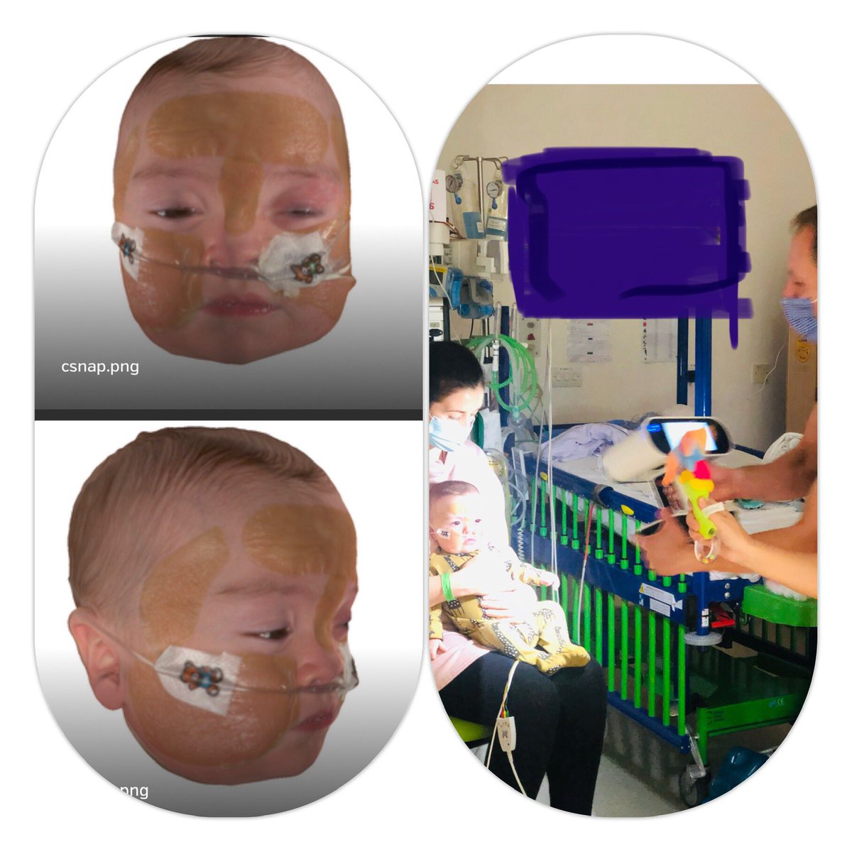 Bespoke 3D masks being made to provide Long term ventilation in children <a href="/RMCHosp/">RMCHosp</a> <a href="/RMCH_Ward83/">RMCH Ward 83</a> <a href="/RMCH_Ward85/">RMCH_Ward85</a> @RMCH_Crit_Care. #research