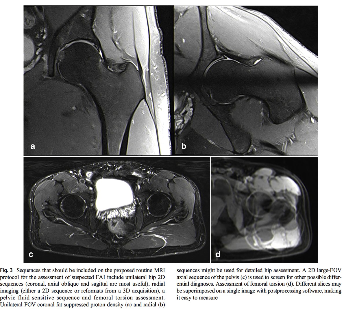 FAI week! Parts 2 & 3 of Lisbon "trilogy" on FAI imaging Control Hip Hype!Part 1:  https://pubmed.ncbi.nlm.nih.gov/32405754/&nbsp;Part 2:  https://pubmed.ncbi.nlm.nih.gov/33411052/&nbsp;Part 3:  https://pubmed.ncbi.nlm.nih.gov/33411053/&nbsp;Hip Hype:  https://pubmed.ncbi.nlm.nih.gov/30699445/&nbsp; Young Hip Webinar #3 Friday:  https://www.ndorms.ox.ac.uk/events/Oxford-Hip-2021 #hip  #sportsmedicine