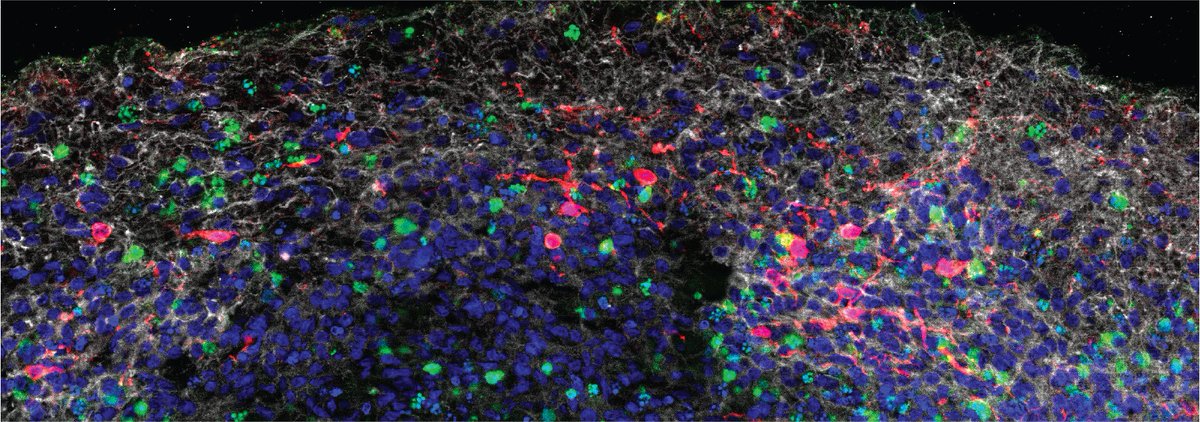 Using both mouse and human brain tissue, researchers at @YaleMed have discovered that #SARSCoV2 can directly infect the central nervous system and have begun to unravel some of the virus’s effects on brain cells (bit.ly/38BjLbA). Press release: bit.ly/3qbXrLD