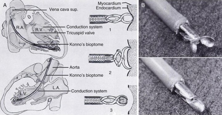 2/Congo  staining of amyloid deposits in tissue obtained via endomyocardial biopsy (EMB) is the definitive way of dx'ing CA   EMB however is not widely available & pretty invasive. out the *OG* myotome from Konno et al in their 1963 article https://pubmed.ncbi.nlm.nih.gov/14072735/&nbsp;