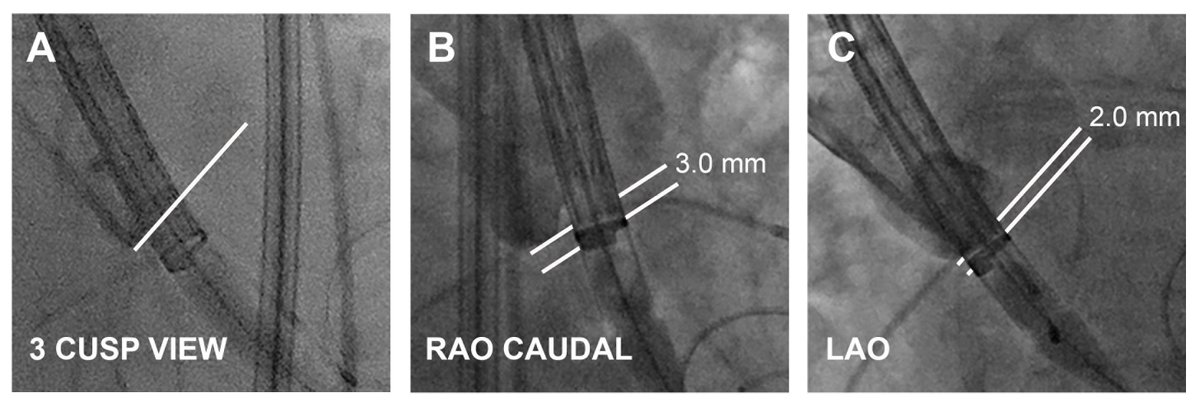 CircInterventions (@circintv) on Twitter photo Can use of annular plane projections for self-expanding #TAVR implantation lessen the need for permanent pacing? A retrospective analysis. ahajournals.org/doi/abs/10.116… <a href="/DrAnthonyP/">Anthony D Pisaniello</a> <a href="/cardiacpolymath/">Matt Daniels MD PhD</a> @MFTNHS <a href="/MFT_MRI/">Manchester Royal Infirmary</a> <a href="/DCVS_UoM/">Division of Cardiovascular Sciences</a> #AHAJournals #ACCFIT Can use of annular plane projections for self-expanding #TAVR implantation lessen the need for permanent pacing? A retrospective analysis. ahajournals.org/doi/abs/10.116… <a href="/DrAnthonyP/">Anthony D Pisaniello</a> <a href="/cardiacpolymath/">Matt Daniels MD PhD</a> @MFTNHS <a href="/MFT_MRI/">Manchester Royal Infirmary</a> <a href="/DCVS_UoM/">Division of Cardiovascular Sciences</a> #AHAJournals #ACCFIT
