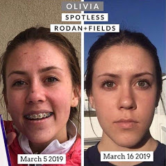 RFlovesyourskin's tweet photo. #acne #acneproblems #acneproneskin #teenageacne #youngadultacne Do you need help fighting your teenage / young adult acne? Spotless is a sure solution to your acne problems. info - https://t.co/cBTdUKPGVc Number 1 Anti-aging Skincare Brand https://t.co/ycoryAPQJ2 via @pinterest https://t.co/Z4HP8AbBC0