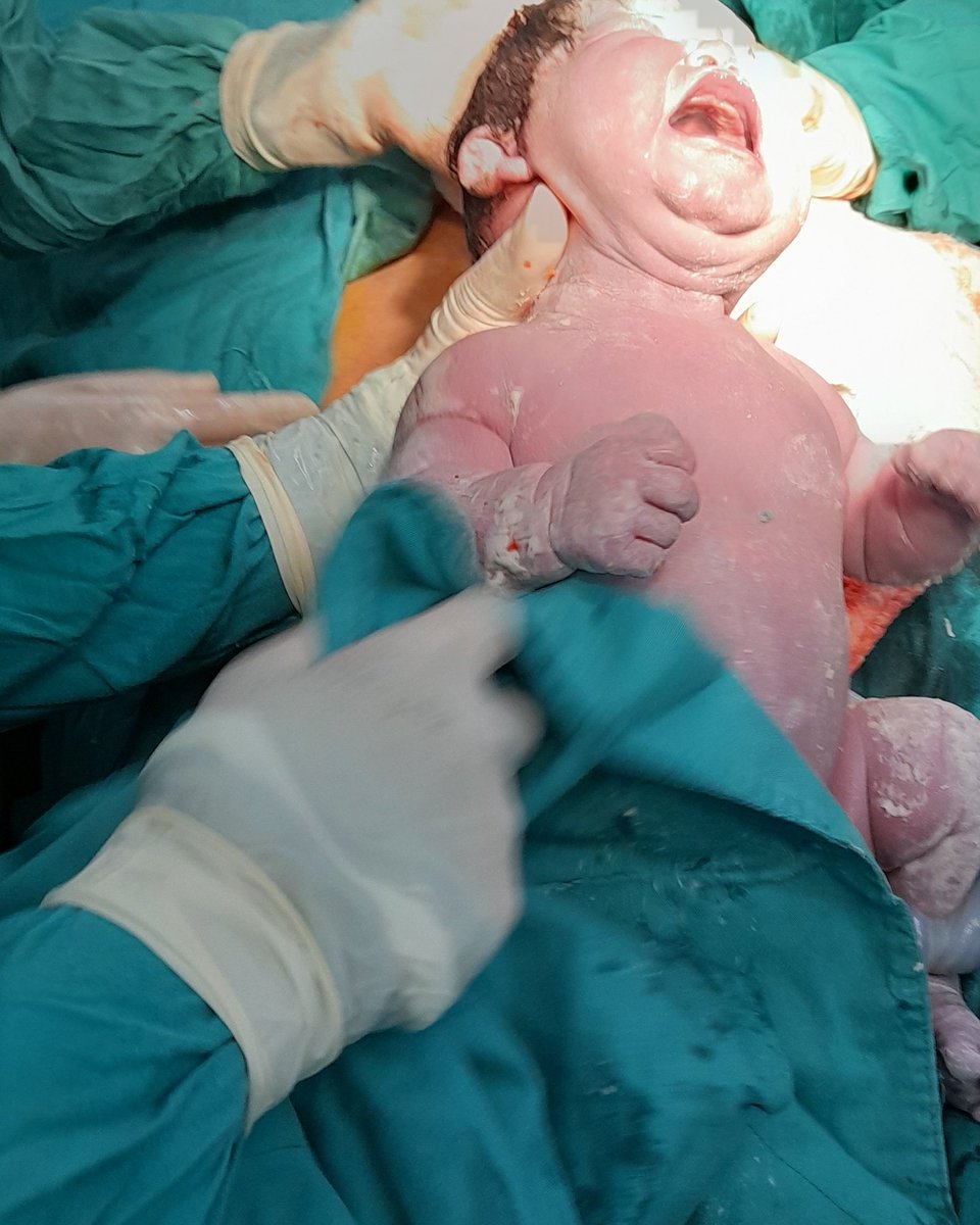 Niñi hermoso, pero es hijo de madre diabética de mal control en su embarazo