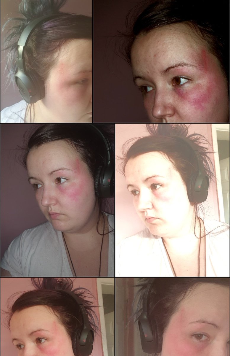KeeleyTalks's tweet photo. ⚠️⚠️ triger warning ⚠️⚠️ the fake bruise in different lighting.. this is just lipstick https://t.co/L3QIomeBHI