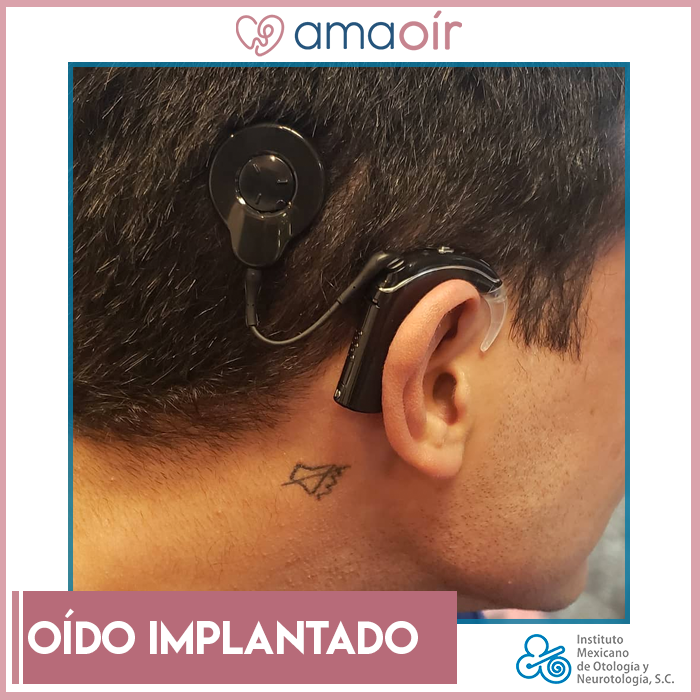 Una vez que se coloca el implante ¿El oído implantado queda inservible fisiológicamente? No necesariamente; los electrodos están diseñados para preservar la audición residual, aunque no siempre se logre.