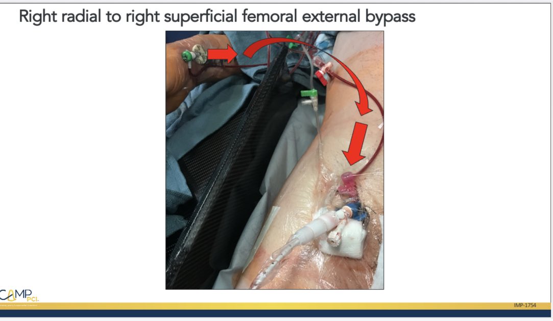 HadyLichaaMD's tweet image. #LendaHand #SaveaLeg 
After ur lifesaving cardiac work avoid M/M by saving a leg with indwelling #LargeBore

vimeo.com/490934984/953a…

@RajTayalMD @DrAmirKaki @mmamas1973 @AGoldsweig @ekgpdx @Babar_Basir @mirvatalasnag @NavinKapur4 @duanepinto @EricSecemskyMD #Cardiotwitter #NCSI