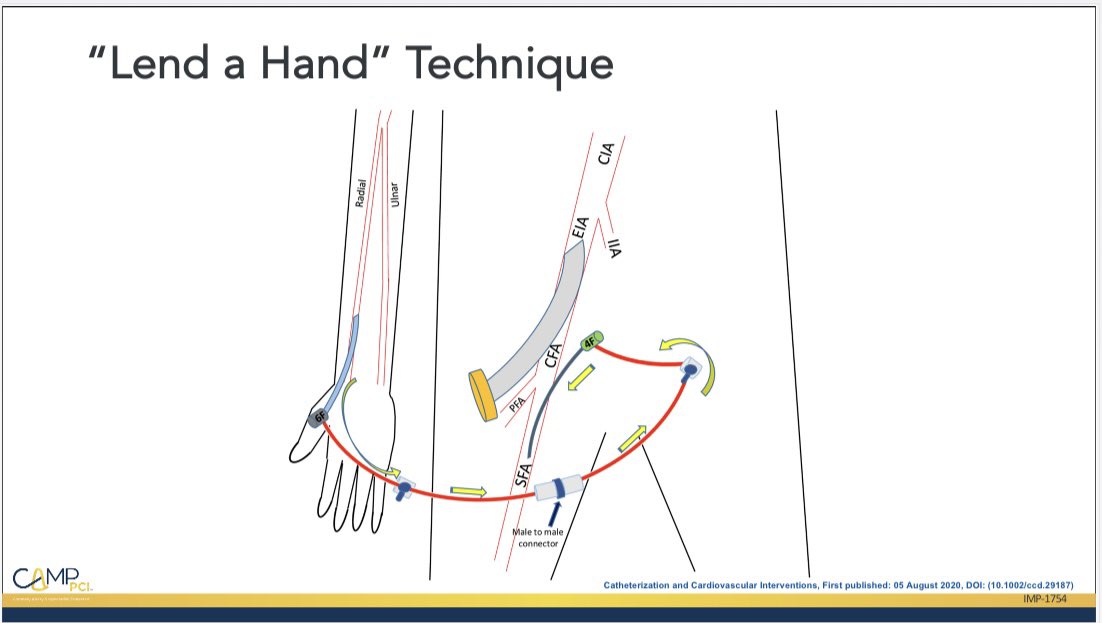 HadyLichaaMD's tweet image. #LendaHand #SaveaLeg 
After ur lifesaving cardiac work avoid M/M by saving a leg with indwelling #LargeBore

vimeo.com/490934984/953a…

@RajTayalMD @DrAmirKaki @mmamas1973 @AGoldsweig @ekgpdx @Babar_Basir @mirvatalasnag @NavinKapur4 @duanepinto @EricSecemskyMD #Cardiotwitter #NCSI