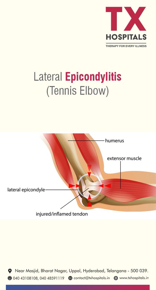 HospitalsTx's tweet photo. Lateral Epicondylitis
#tenniselbow #tenniselbowtreatment #sportsmedicine #epicondylitis #BestSportsMedicineinHyderabad #bestmultispecialityinhyderabad #multispecialityhospitalsinhyderabad #BestOrthopaedicsinHuderabad 
#BestOrthopaedicSurgeoninHyderabadwww.txhospitals.in https://t.co/fOwNBNHMzk