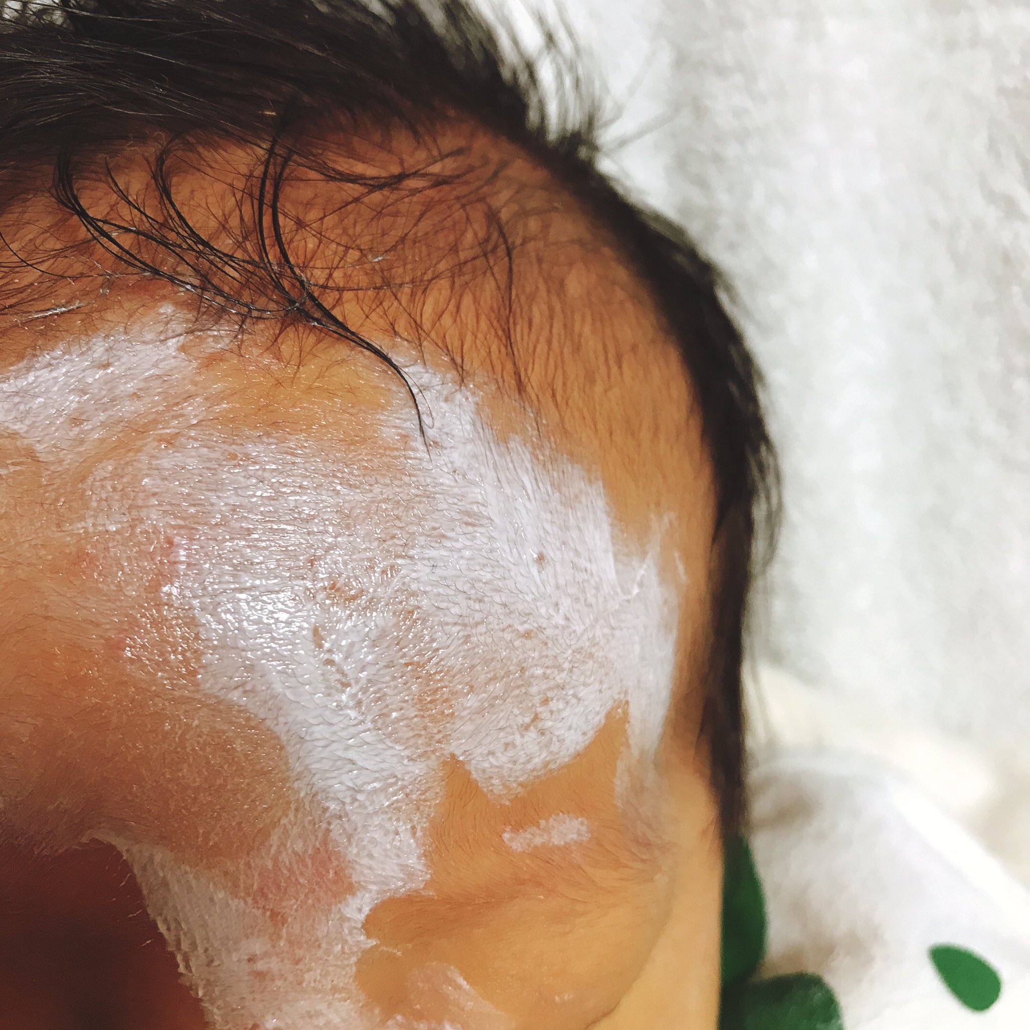 とおり 1歳 亜鉛華単軟膏 サトウザルベ10 を塗っていて真っ白の赤ちゃん 8日に処方してもらって 毎日塗っているが ほっぺた炎症もだいぶ落ち着いてきた サトウザルベはオムツかぶれにも良いらしい T Co Hqqtfalkmy Twitter