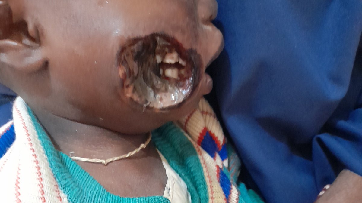 #NOMA has all the peculiarities of NTDs; found among the poor, with zoonotic component,#WASH related causing blindness and stigma. Also,it is an indicator of inequality and has high mortality (70-90%)
However, it is yet to be officially recognised as an #NTD 

#ZeroNOMA 
<a href="/RSTMH/">Royal Society of Tropical Medicine and Hygiene</a>