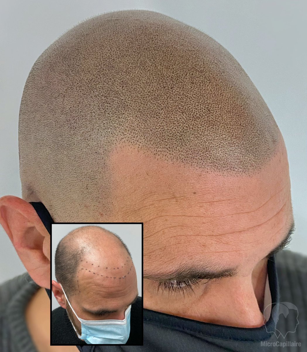 microcapillaire's tweet photo. Scalp micropigmentation is a non surgical hair loss solution. Free consultations https://t.co/9AfpB4Rf3C

#scalpmicropigmentation #smp #hairlosssolution #laval #montreal https://t.co/cQQUU0rOjX