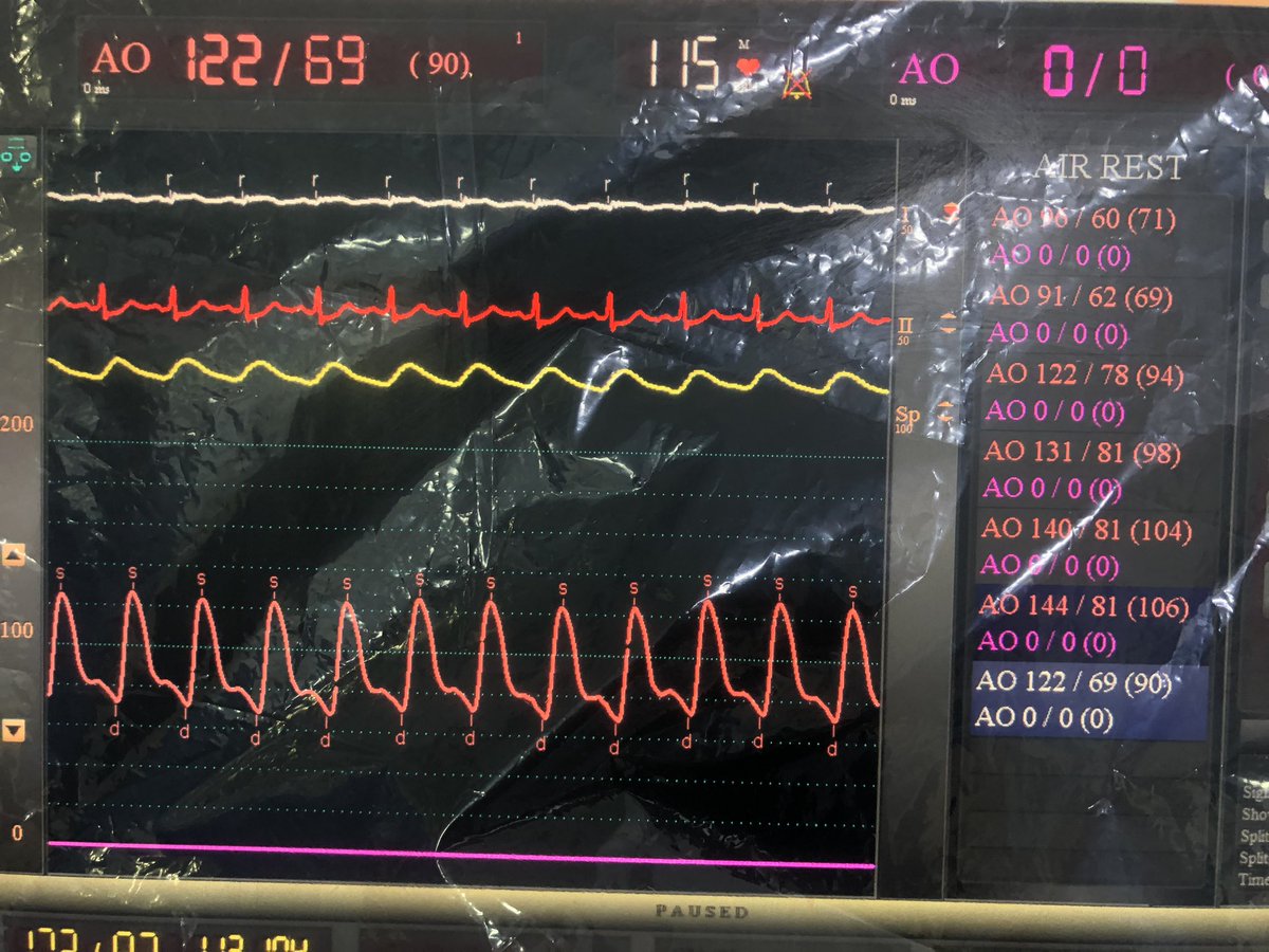 Tamponade. Arterial tracing showing significant respiratory variation. Pericardiocentesis done and 400ml removed. This is the tracing after removing the fluid.
