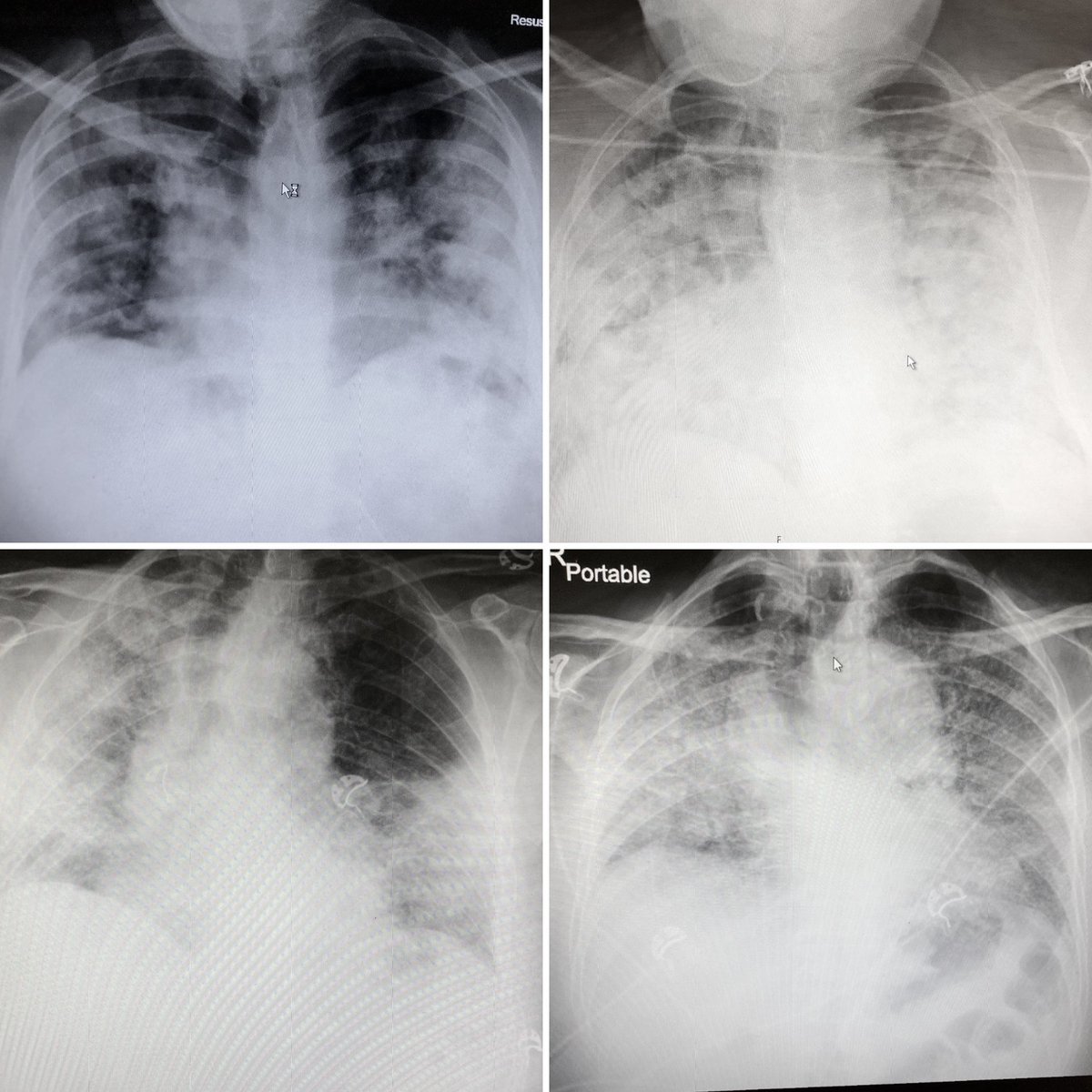 I’m really really really really really really sick of this disease now...

Seeing people gasping for breath. 

Trying to explain over the phone in the middle of the night just how unwell a relative is. 

Doing it over and over and over again all day every day.

It feels endless.