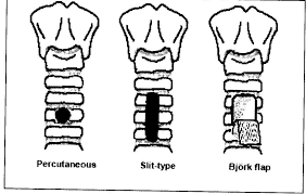  #JanuAirway Traches = surgical / percutaneous. 3 main surgical techniques –window, slit & Bjork flap. Important difference = time for tract maturity: - Perc – 7-10daysSurgical 2-4daysImportant in decannulation, false tract can occur if trach re-inserted before maturity!5/9