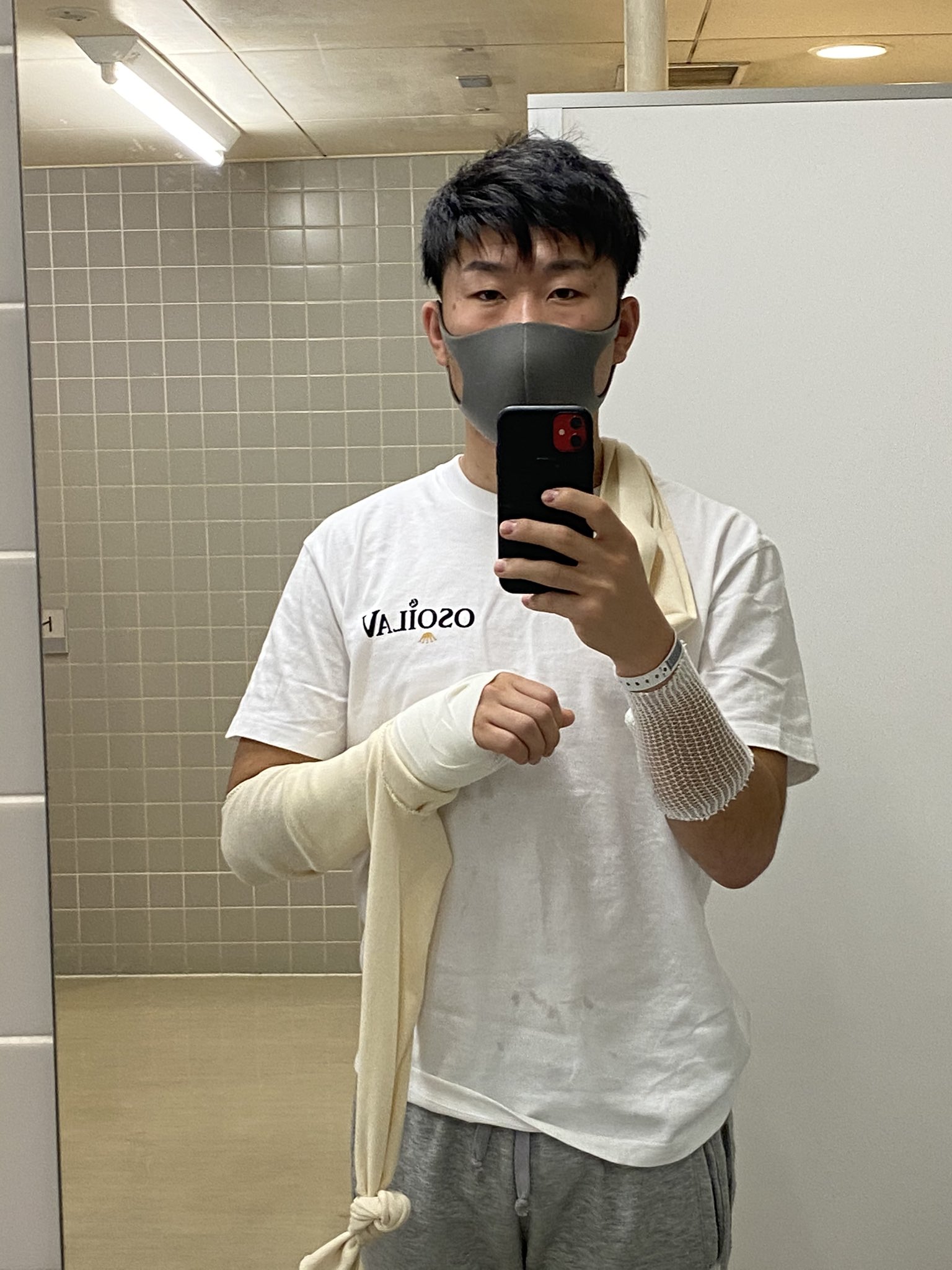 飯田 千馬 昨日手術終わりました 指先の痺れと痛みがありますが昨日よりは良くなってきています 全治6ヶ月と少し長いですが この期間に出来ることをしてパワーアップして戻れる様に頑張ります 舟状骨骨折 舟状骨偽関節 手術 フットサル ゴレイロ