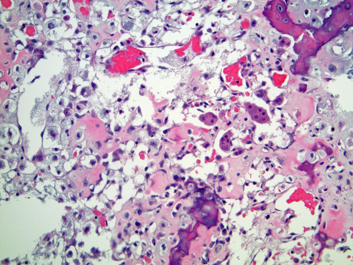 Scott Kilpatrick, MD (@scottbikeethan) on Twitter photo 40+ year old female with a left 4th rib lesion. CT scan with pics. Thoughts? Making bone? Making cartilage? <a href="/smlungpathguy/">Sanjay Mukhopadhyay</a> <a href="/reith16/">John Reith</a> <a href="/JMGardnerMD/">Jerad Gardner, MD</a> #BSTpath 40+ year old female with a left 4th rib lesion. CT scan with pics. Thoughts? Making bone? Making cartilage? <a href="/smlungpathguy/">Sanjay Mukhopadhyay</a> <a href="/reith16/">John Reith</a> <a href="/JMGardnerMD/">Jerad Gardner, MD</a> #BSTpath