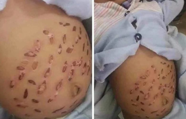 alhelalsurg's tweet photo. الكي للاطفال..
-لا يعالج اورام البطن.
-لا يعالج انقلاب المعده.
-لا يعالج الامساك وانتفاخ البطن.
-لا يعالج التطريش والهزال.
-لا يعالج ضيق النفس المتكرر والتهاب الصدر.
-لا يعالج تشوهات القفص الصدري.
-لا يعالج فتوق جدار البطن الاماميه والاربيه.
بل يتسبب بالآم ،وتشوهات وذكرىٰ مريره. https://t.co/e1E1rGgGaG
