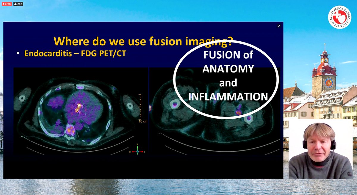 SwissCardio's tweet image. #Deformation/#FusionImaging highlights - Prof. Bax: 1/2
❤️Understanding any disease requires assessment of anatomy, function, and presence of inflammation. 
❤️Fusion of different imaging modalities that provides such info allow better understanding of disease status.
@SwissCardio