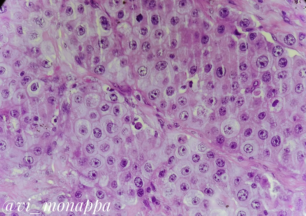 vi_monappa's tweet photo. Long time since I posted something. #LNpath #pathology #pathresidents 
Elderly male LN bx. Morphologic diagnosis. No IHC. What will u call this ? See poll below 👇 https://t.co/RhCOsurc0E