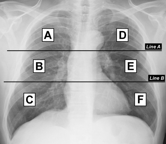 RadiolMed's tweet photo. The most-cited 2020 papers of @RadiolMed on @webofscience and @Scopus: 
First position in the ranking: Chest Radiology/
COVID-19 outbreak in Italy: experimental chest X-ray scoring system for quantifying and monitoring.
https://t.co/7kiyqmLBLp
#Covid #radiology @unibs_official https://t.co/9inSHfOzdb