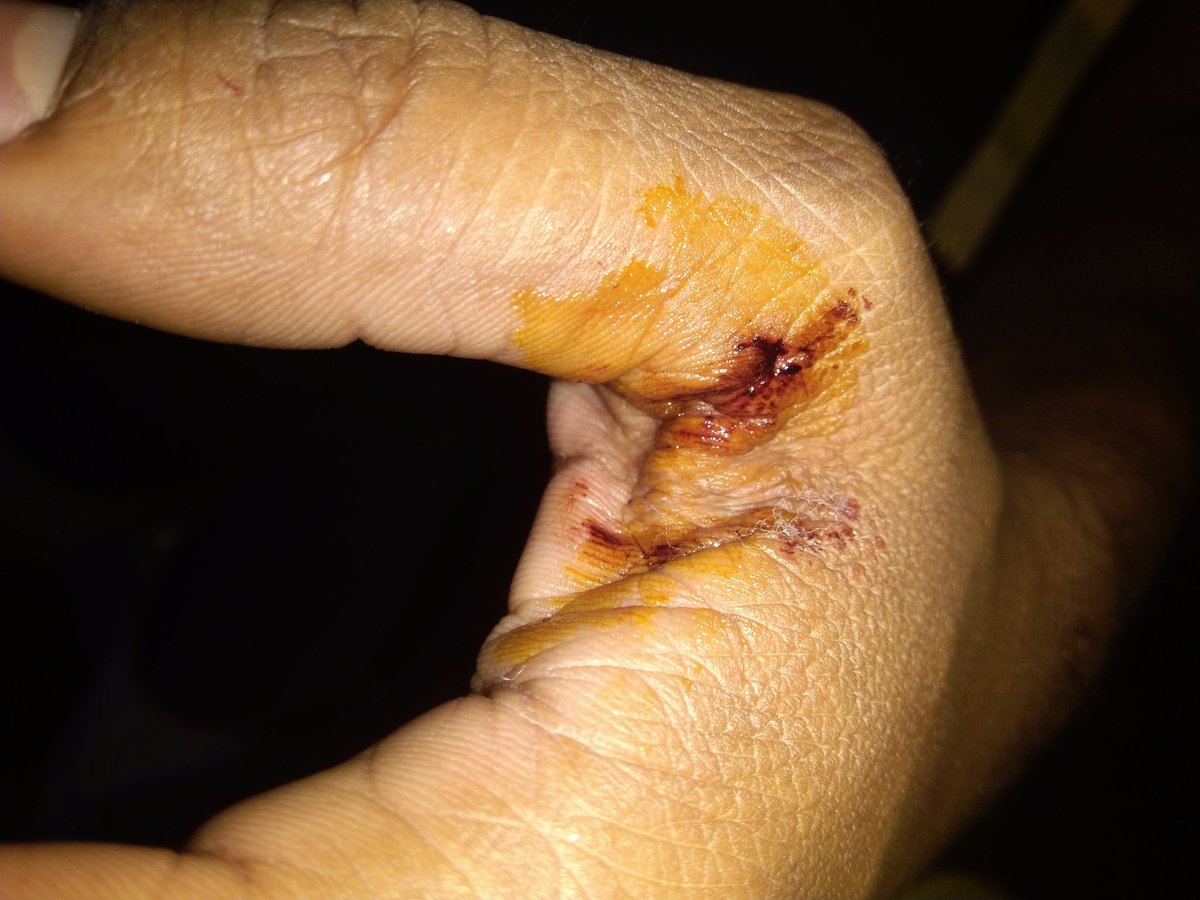 SindhuParupelli's tweet photo. @TelanganaCOPs @KTRoffice @KTRTRS @cyberabadpolice my husband and his colleague are returning to home on bike from office at around 4pm glass powder treated thread or Chinese thread suddenly wrapped around their neck and caused severe injury. https://t.co/GLPIxW3XJA