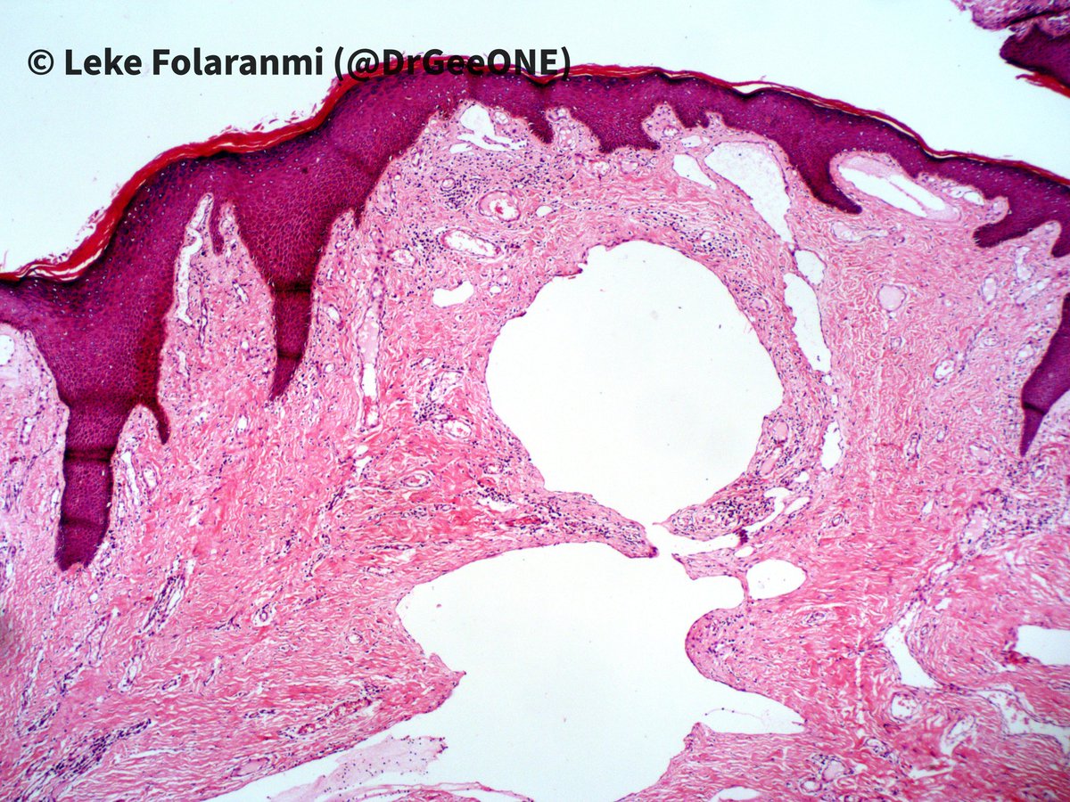 DrGeeONE's tweet photo. Wart-like lesions on the scrotal skin of an adult male with urethral stricture...
(Clinically, the diagnosis would be warts in a world with no pathologists @osheguy @ojayfemi )🤣😅
#Dermpath
Acquired lymphangioma circumscriptum? @HENRYY_MD @redsnapperpath @ChristineJKoMD https://t.co/ABzmFXDPtT