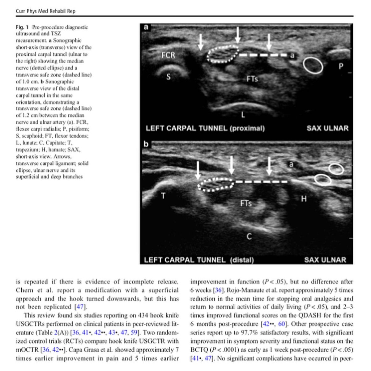 ErekLatzkaMD's tweet photo. 🔥 Hot off the press!
🗞 Evidence for #Ultrasound Guided #CarpalTunnelRelease
➡️ https://t.co/d2TpUdmrzc
#sportsmedicine #minimallyinvasive #handsurgery #ortho #sonex #guothread #hookknife @UWRehabMed @Swedish @mayoclinicsport @SpringerNature @SonexHealth @AAPMR @TheAMSSM https://t.co/4AAUkPMIZS
