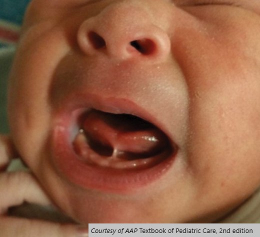 AAPNews's tweet photo. About 4%-11% of newborns are born with tongue-tie. Here is evidence pediatricians can use to determine whether surgical intervention is necessary: https://t.co/wGL8s7IbJC  #AAP2020 https://t.co/T1O7uYXnL5