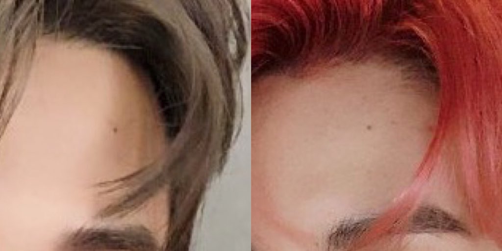 even same mole placement???