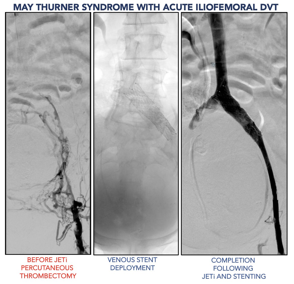 Rameen S. Moridzadeh, MD (@moridzadehmd) on Twitter photo This patient presented with sudden onset of left leg swelling. CT venogram demonstrated iliofemoral DVT with #thrombosis down to the femoral vein. Treated single session using JETi thrombectomy followed by IVUS and iliac vein stenting. #MedEd <a href="/VascSurgLA/">Vascular Surgery Associates</a> This patient presented with sudden onset of left leg swelling. CT venogram demonstrated iliofemoral DVT with #thrombosis down to the femoral vein. Treated single session using JETi thrombectomy followed by IVUS and iliac vein stenting. #MedEd <a href="/VascSurgLA/">Vascular Surgery Associates</a>