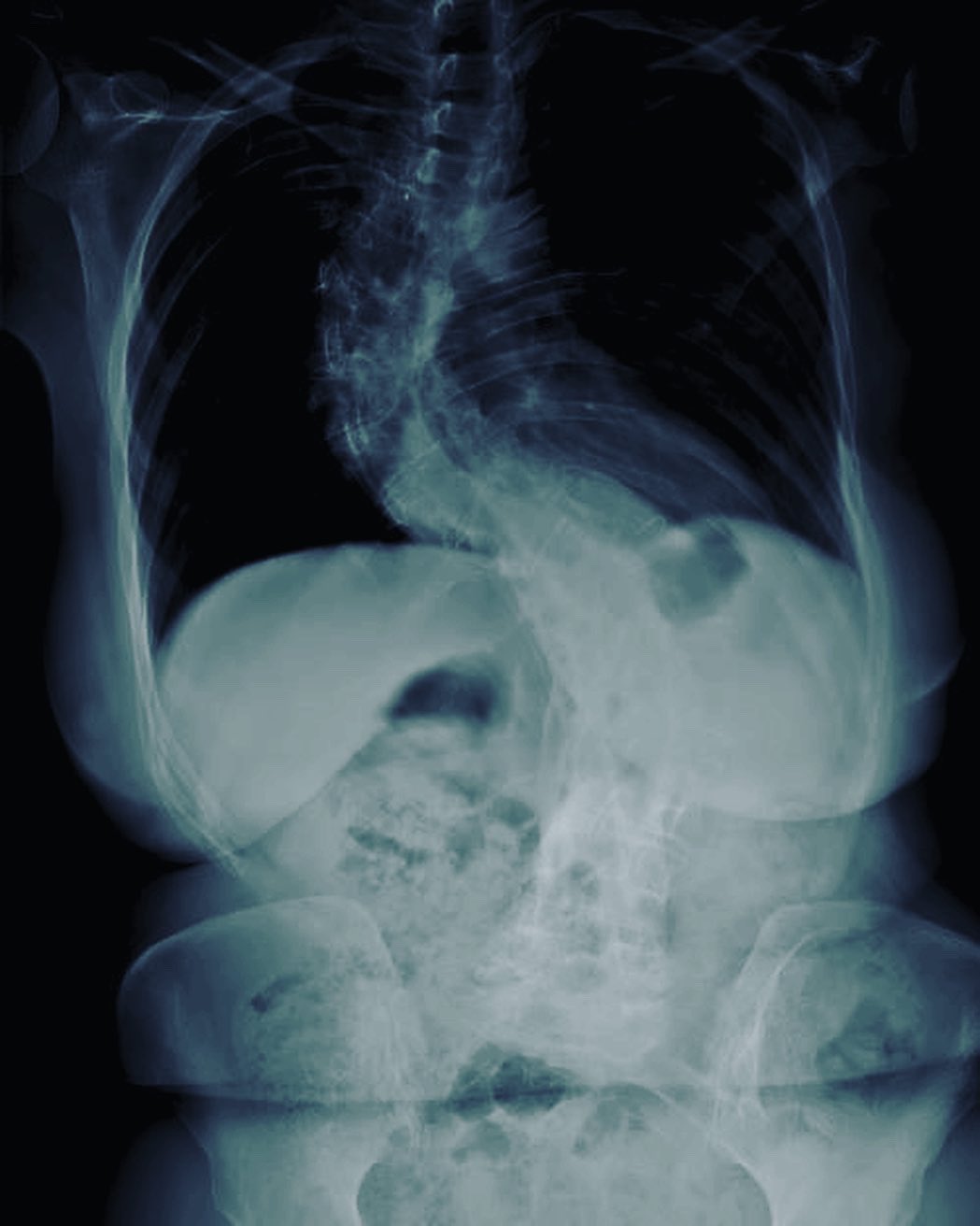 osteochondrosis s1