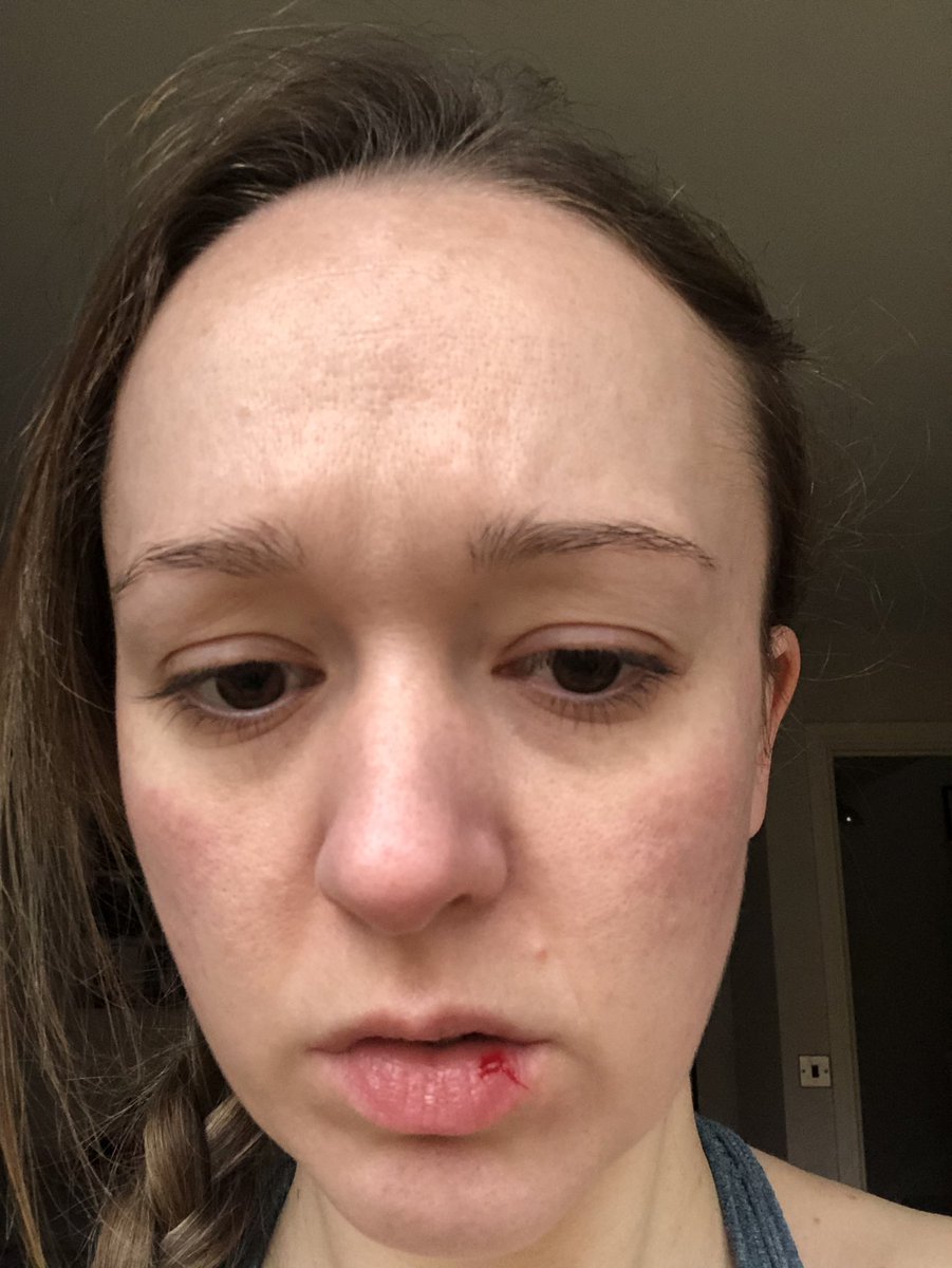 NickiDeane's tweet photo. Bobby did this to me today. Don’t panic, Bobby is one of my cats. Lessons learned:
1. Tie your hair up when exercising.
2. Yoga is more dangerous than advertised.
3. Downward dog &amp; cats don’t mix.
3. I should never take close ups without make up on.
#lockdownuk #catmumproblems https://t.co/ofGMhqWIId