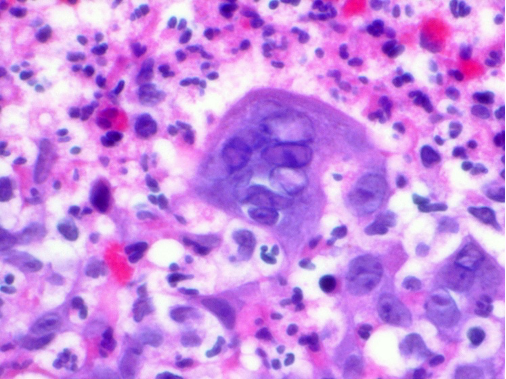 TimBell_Path's tweet photo. Herpes simplex virus (HSV) can be identified histologically with the 3M's.  Multinucleation, nuclear Molding and Margination (of chromatin to the periphery of the nucleus). @KMirza #TwitterHomework https://t.co/yxg5AhZGqv
