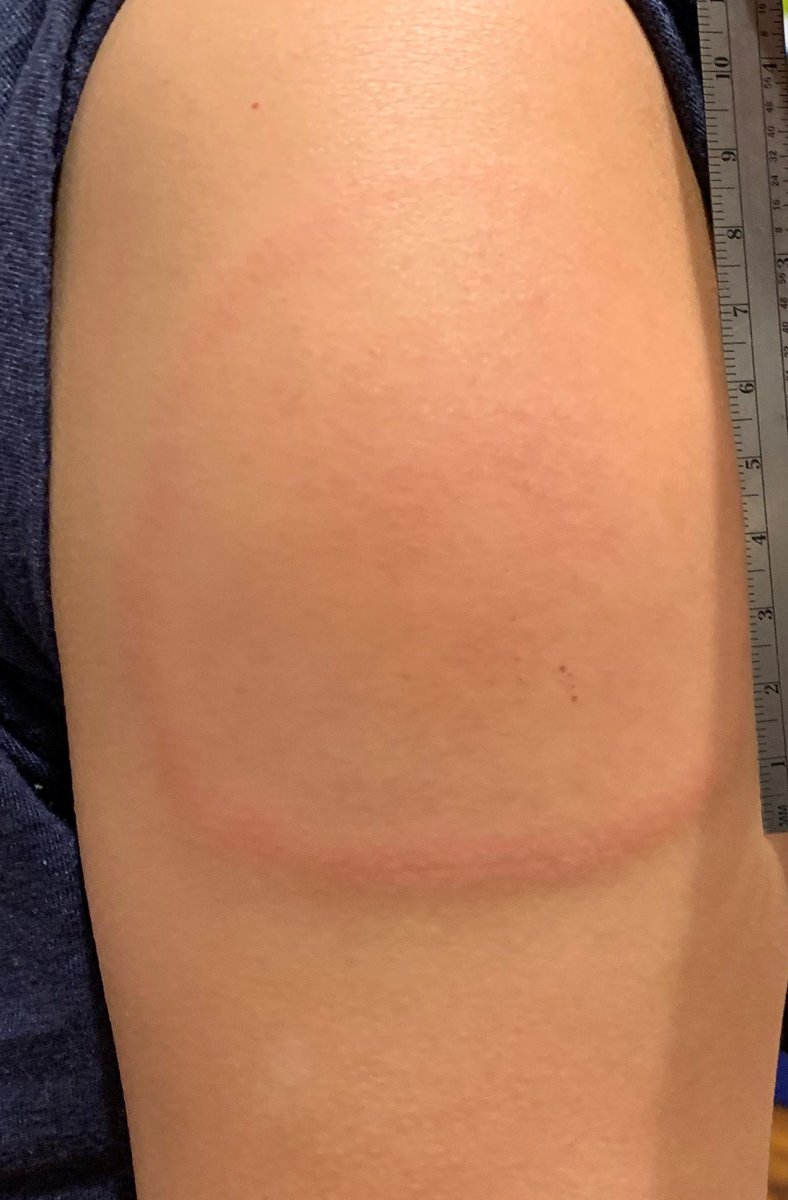 1/Brief  #COVID19vaccine allergy update: LARGE LOCAL REACTIONS! These all were after  #Moderna. Itchy, swollen, erythema, edema. Comes on late (>5 days) and can last weeks .Tx is symptomatic: antihistamine (e.g., fexofenadine), NSAID/Tylenol, ice.
