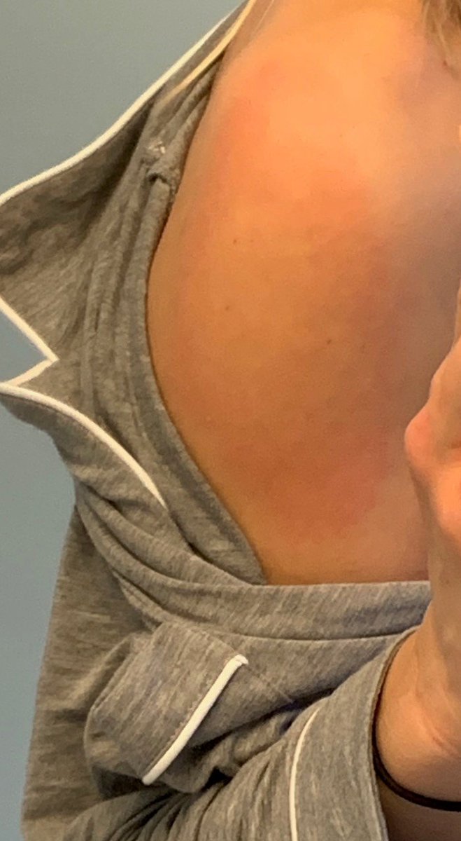 1/Brief  #COVID19vaccine allergy update: LARGE LOCAL REACTIONS! These all were after  #Moderna. Itchy, swollen, erythema, edema. Comes on late (>5 days) and can last weeks .Tx is symptomatic: antihistamine (e.g., fexofenadine), NSAID/Tylenol, ice.