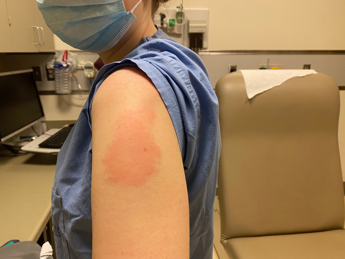 1/Brief  #COVID19vaccine allergy update: LARGE LOCAL REACTIONS! These all were after  #Moderna. Itchy, swollen, erythema, edema. Comes on late (>5 days) and can last weeks .Tx is symptomatic: antihistamine (e.g., fexofenadine), NSAID/Tylenol, ice.