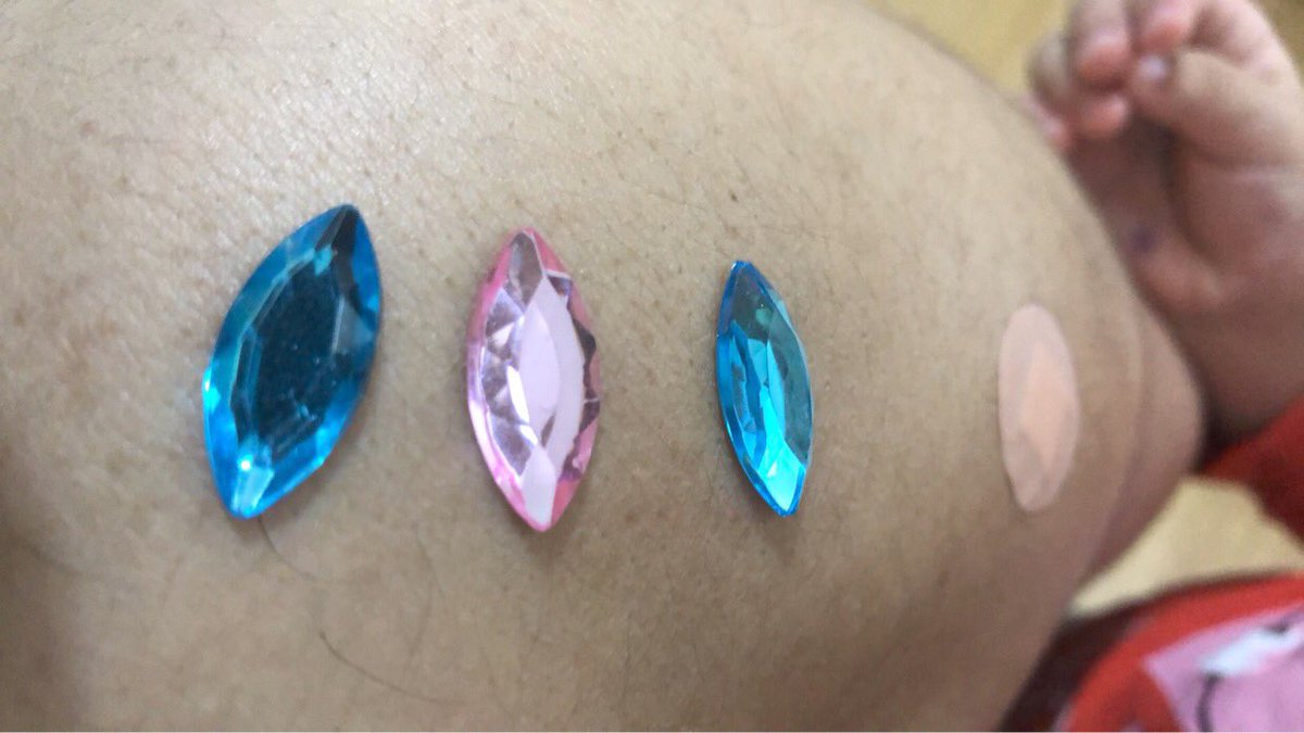 Hossamsaro's tweet photo. Today, I got my COVID-19 vaccination at @GSTTnhs. When I went back home, my 2-year-old daughter put her sticky gems over my shoulder in line with my vaccination dressing. Thanks @GSTTnhs @nhs https://t.co/PNSA0SNj8N