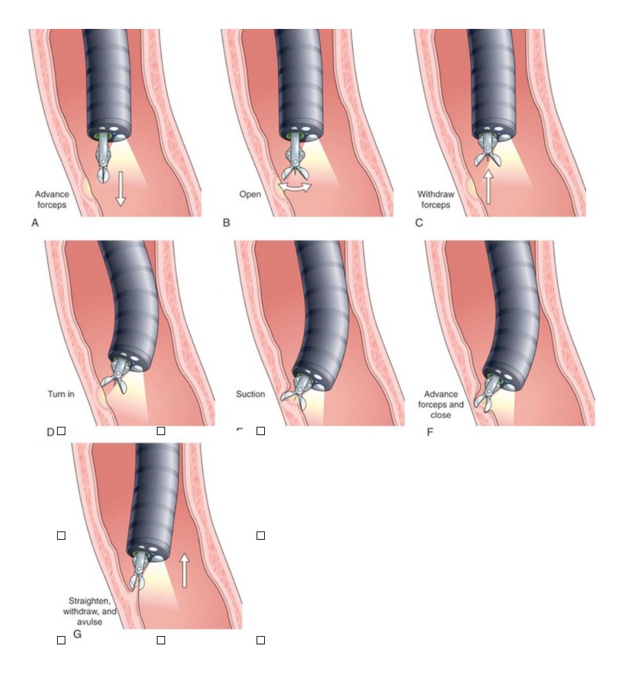 In relation to technique, especially in oesophagus, I love the turn-and-suction technique