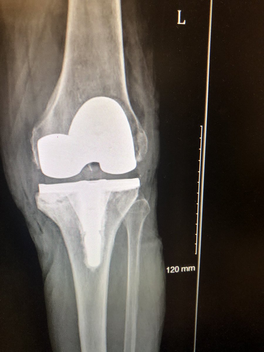 Satisfying case.  Needed a couple tricks to correct the fixed varus.